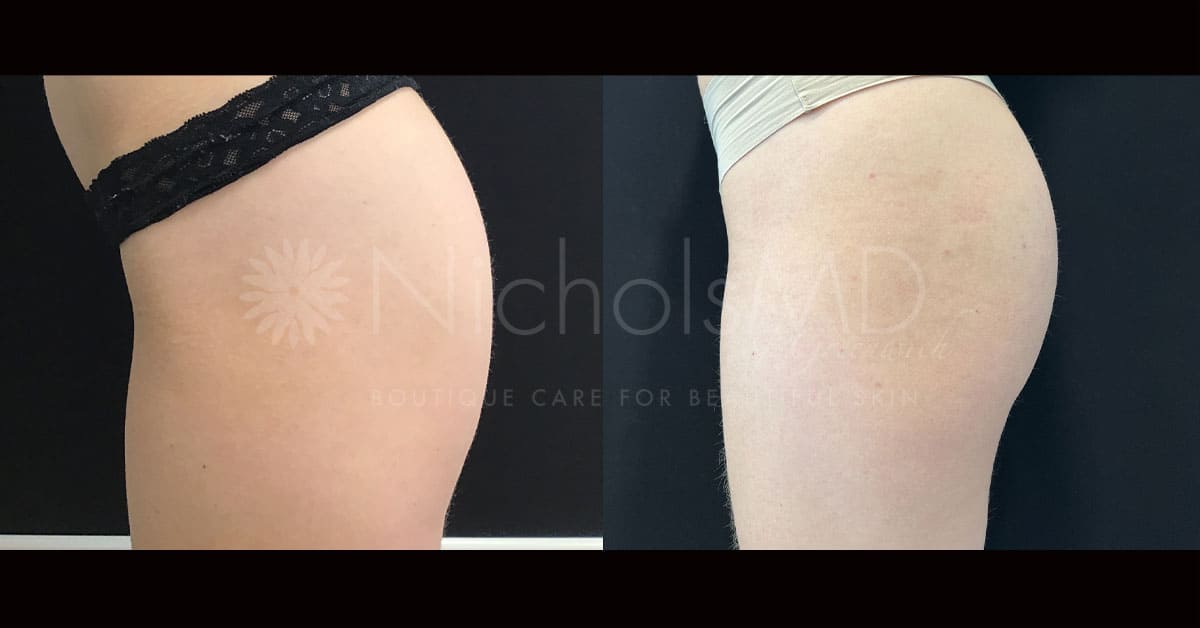 NicholsMD of Greenwich Sculptra Treatment