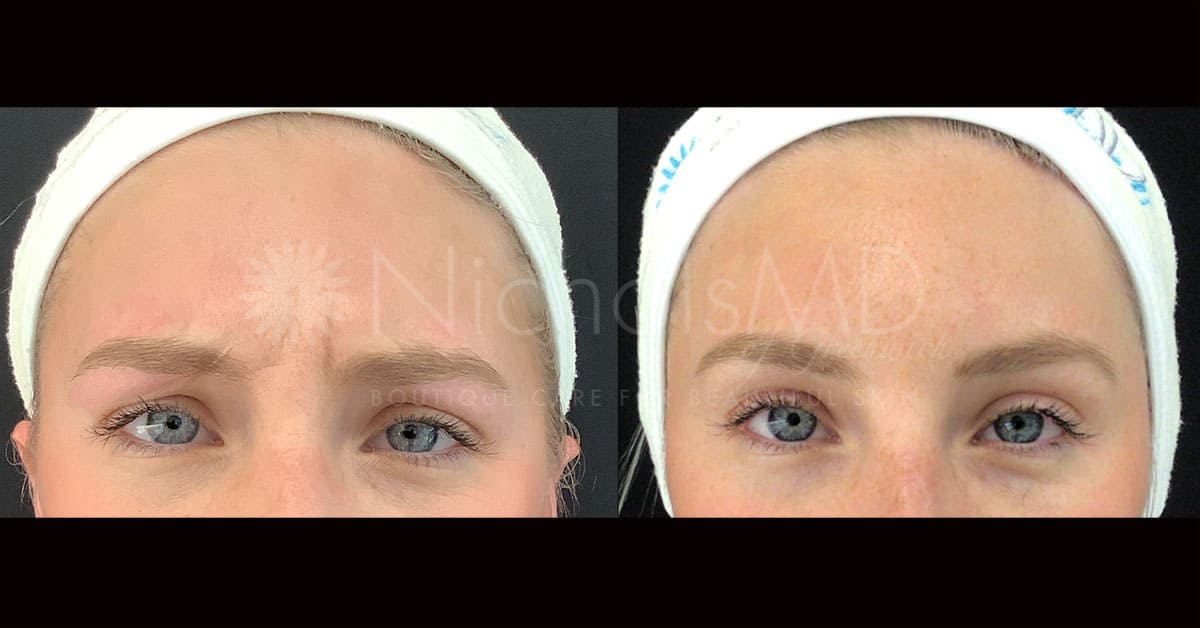 NicholsMD of Greenwich Botox® Treatment