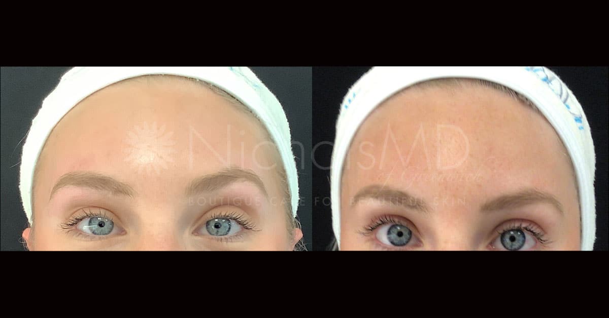 NicholsMD of Greenwich Botox® Treatment