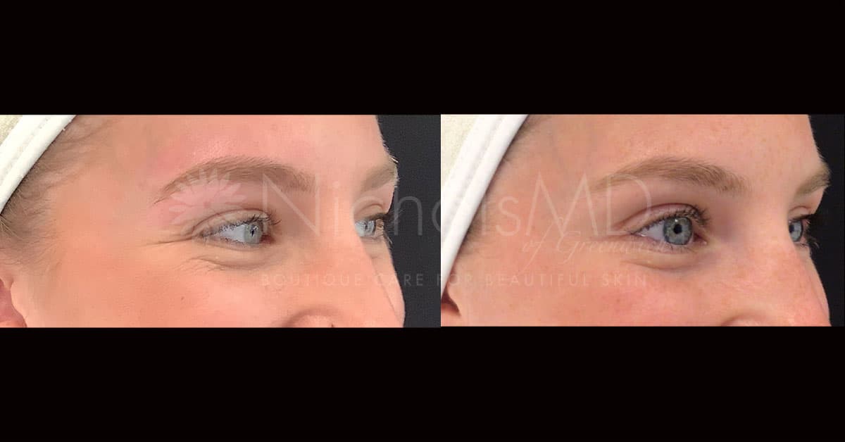 NicholsMD of Greenwich Botox® Treatment