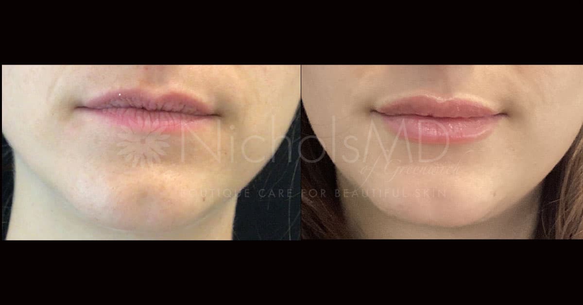 NicholsMD of Greenwich Botox® Treatment