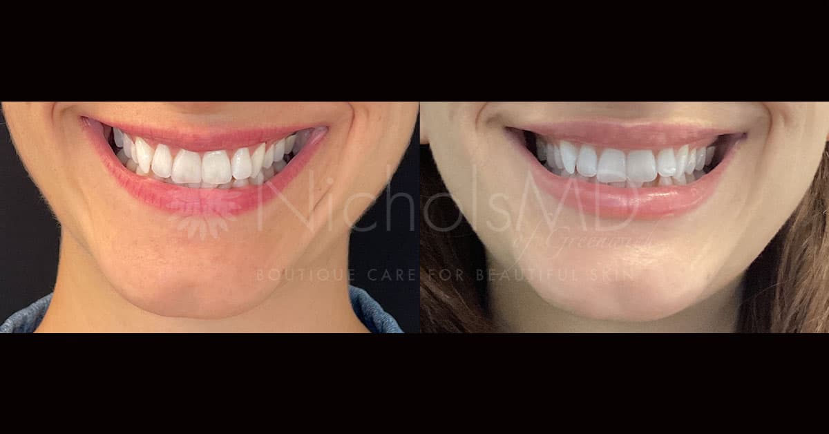 NicholsMD of Greenwich Lip Lift Treatment