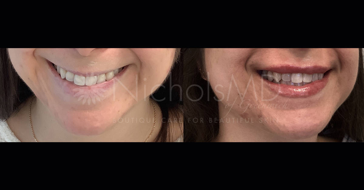 NicholsMD of Greenwich Liquid Lip Lift® Treatment