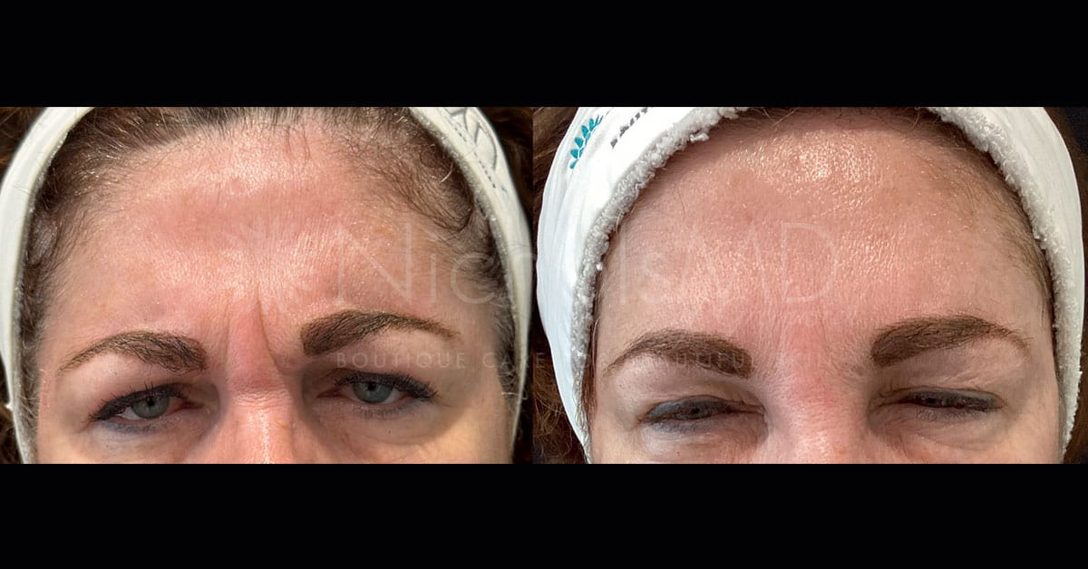 NicholsMD of Greenwich Daxxify Treatment
