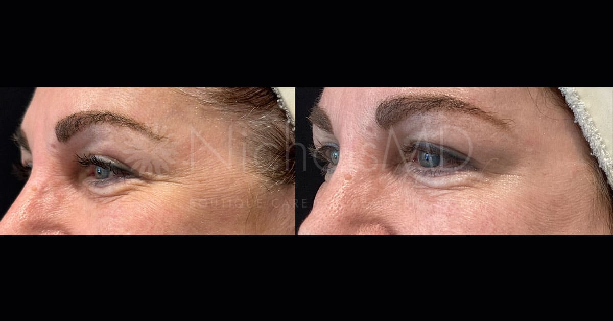 NicholsMD of Greenwich Daxxify Treatment