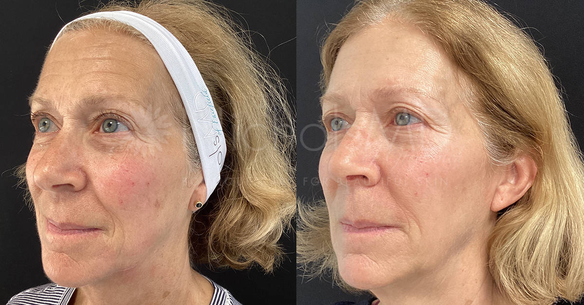 Full-face Rejuvenation with Sculptra