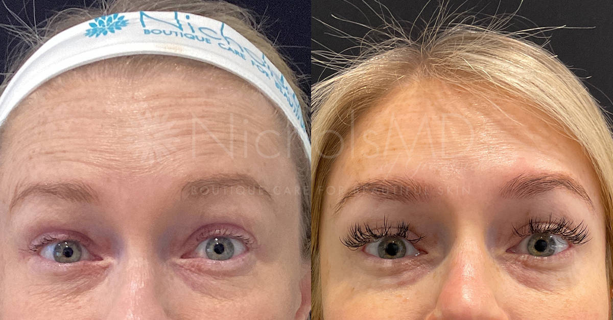 Botox Upper-face