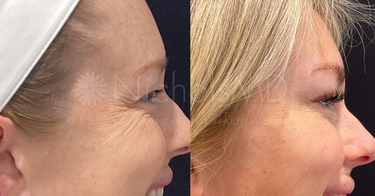 Botox for Crow's Feet