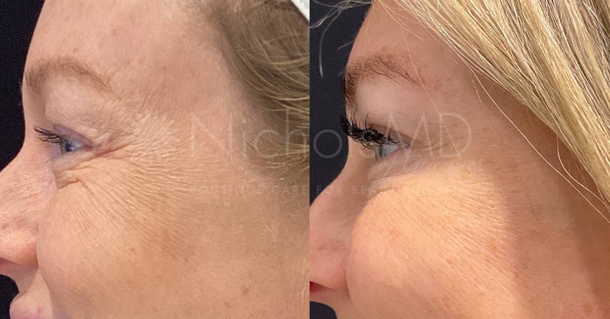 Botox for Crow's Feet