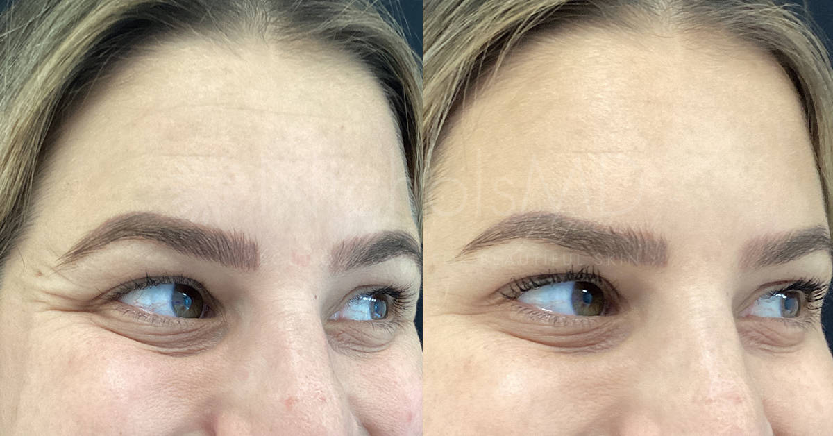 Botox for Crow's Feet