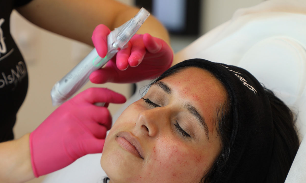 Microdermabrasion