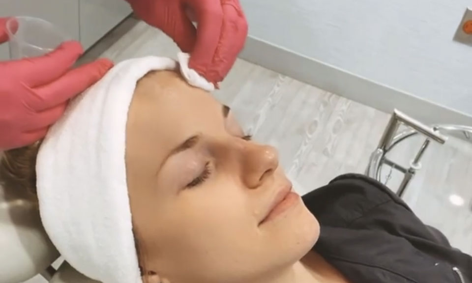 Pore-Refining Chemical Peel