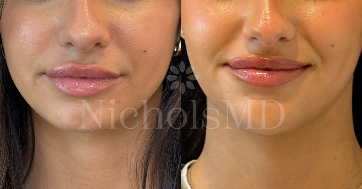 NicholsMD Liquid Jawline Contour with Chin Enhancement, Botox for Facial Slimming, Nefertiti Before and After