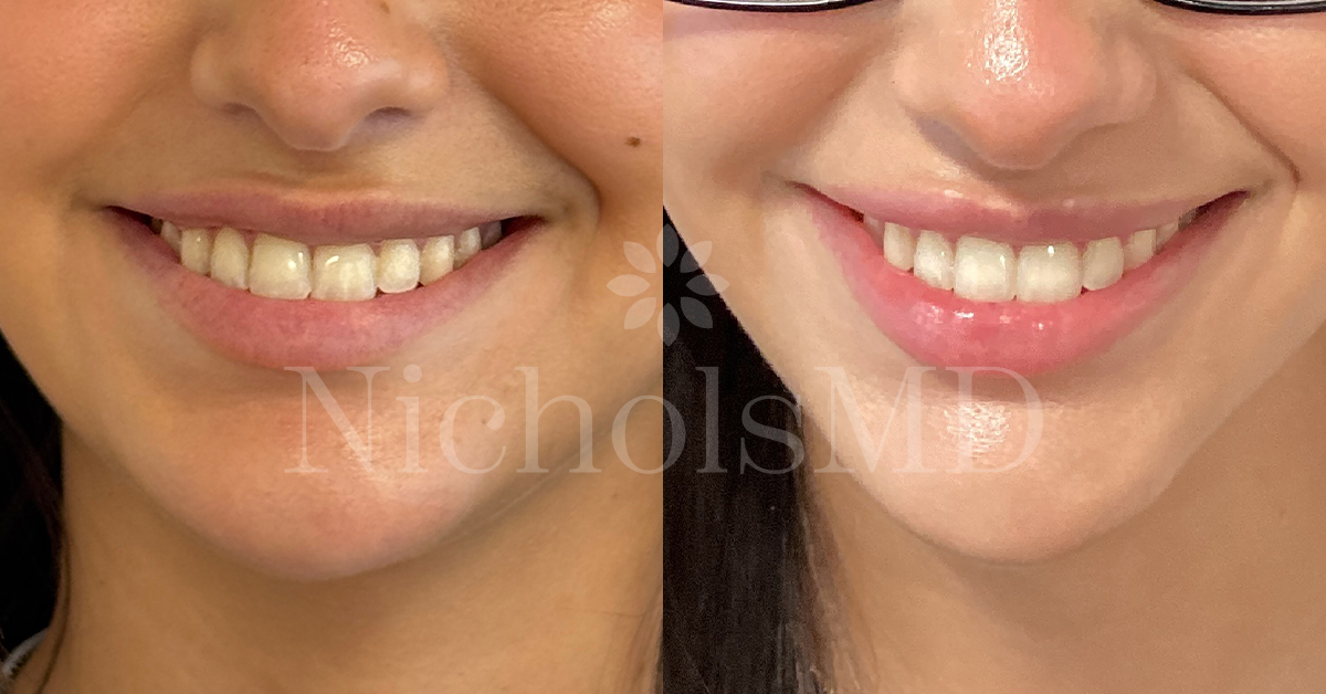 NicholsMD Liquid Lip Lift Before and After