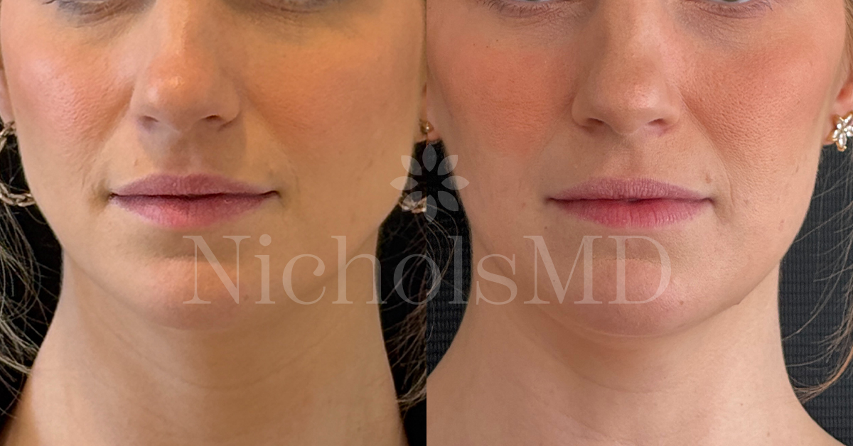 NicholsMD Botox for Facial Slimming Before and After