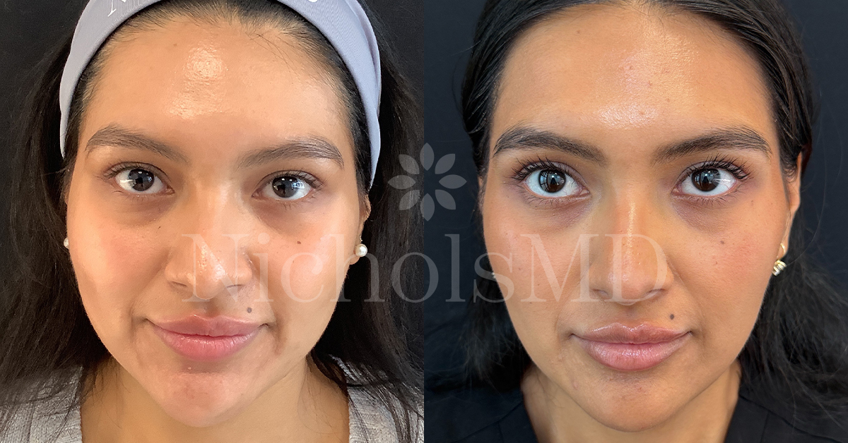 NicholsMD Botox for Facial Slimming Before and After
