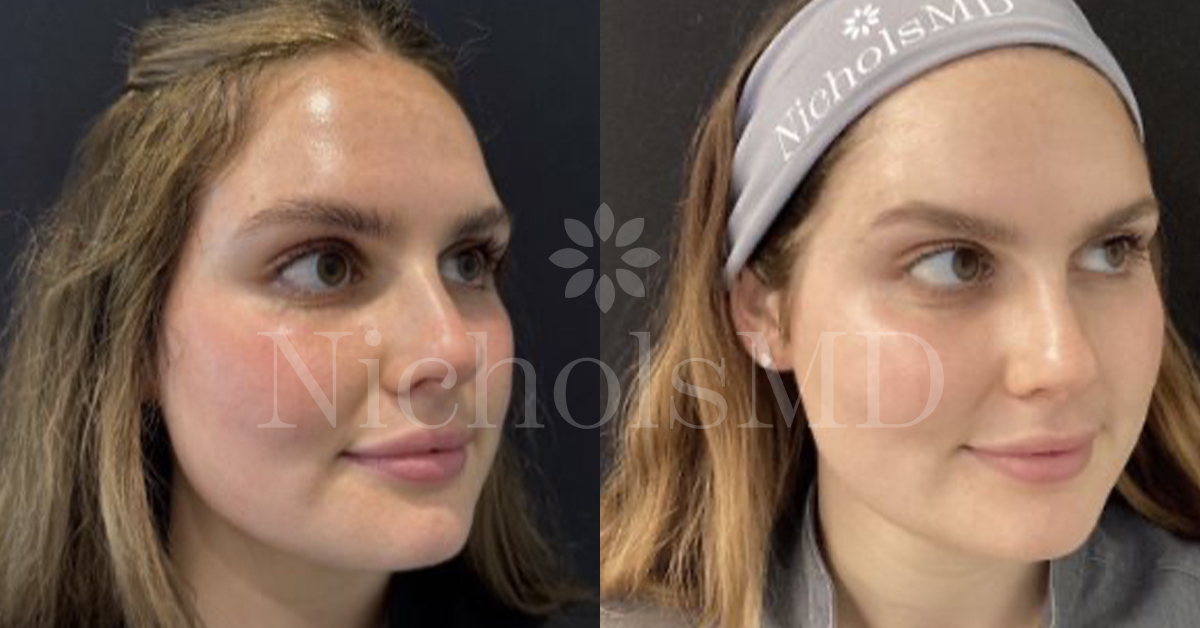 NicholsMD Sculptra Before and After