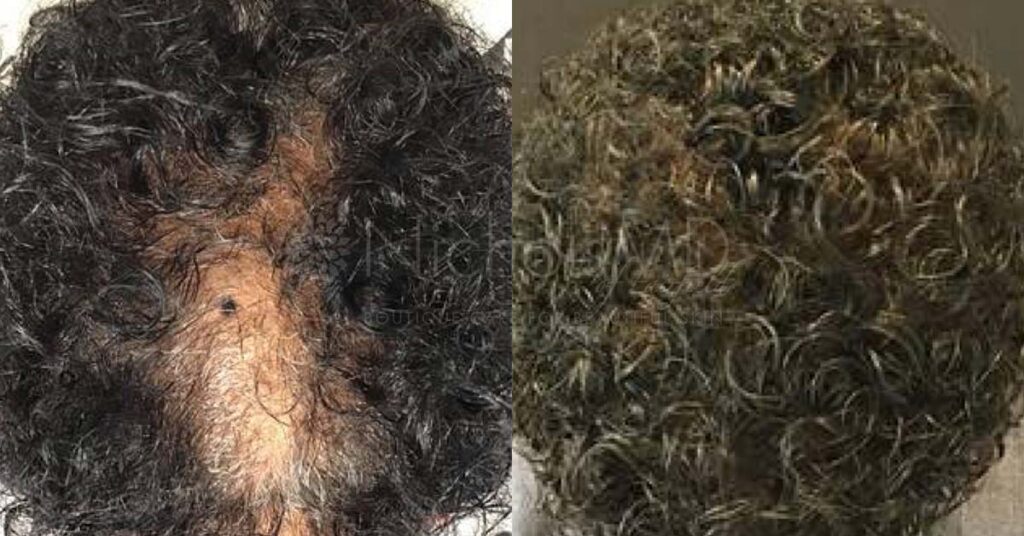 NicholsMD Hair Restoration Before and After