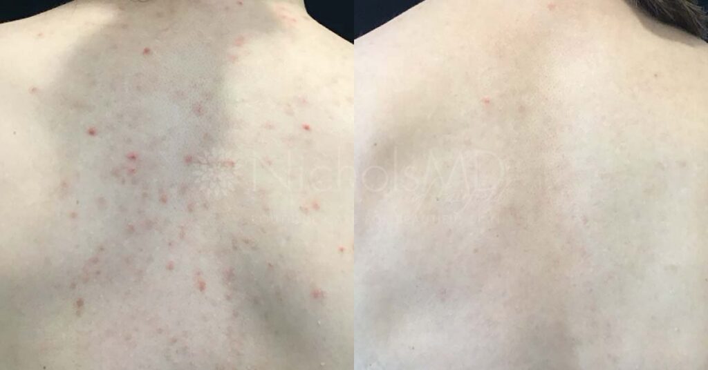 NicholsMD Back Acne Treatment Before and After