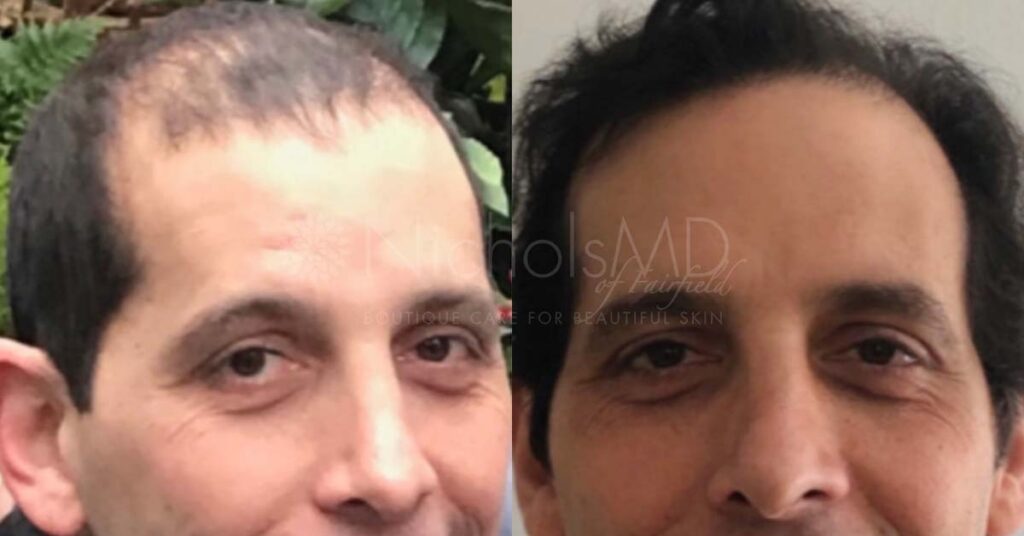 NicholsMD Hair Restoration Before and After
