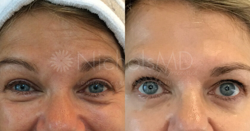 NicholsMD Botox Before and After