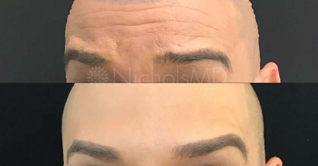 NicholsMD Botox for Forehead Wrinkles Before and After