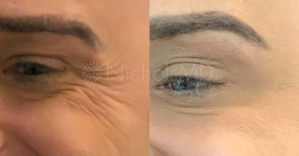 NicholsMD Botox for Crow's Feet Before and After