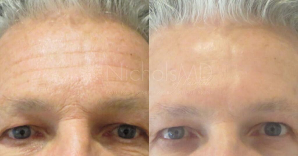 NicholsMD Botox for Forehead Wrinkles Before and After