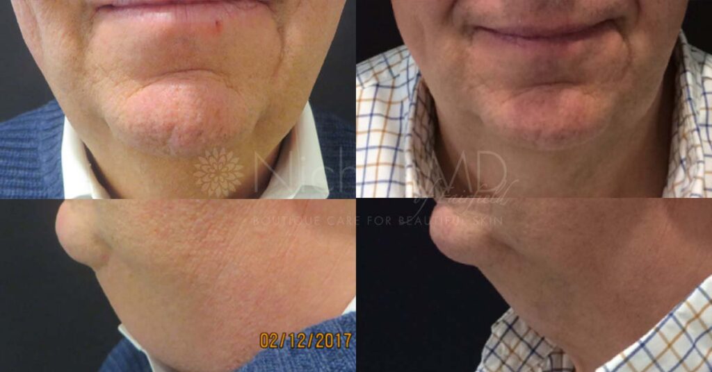 NicholsMD Chin and Neck Treatment Before and After