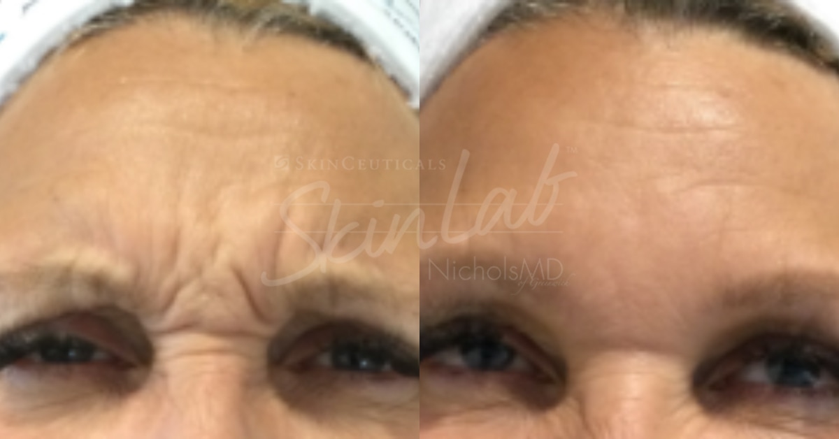 NicholsMD Botox Upper Face Before and After