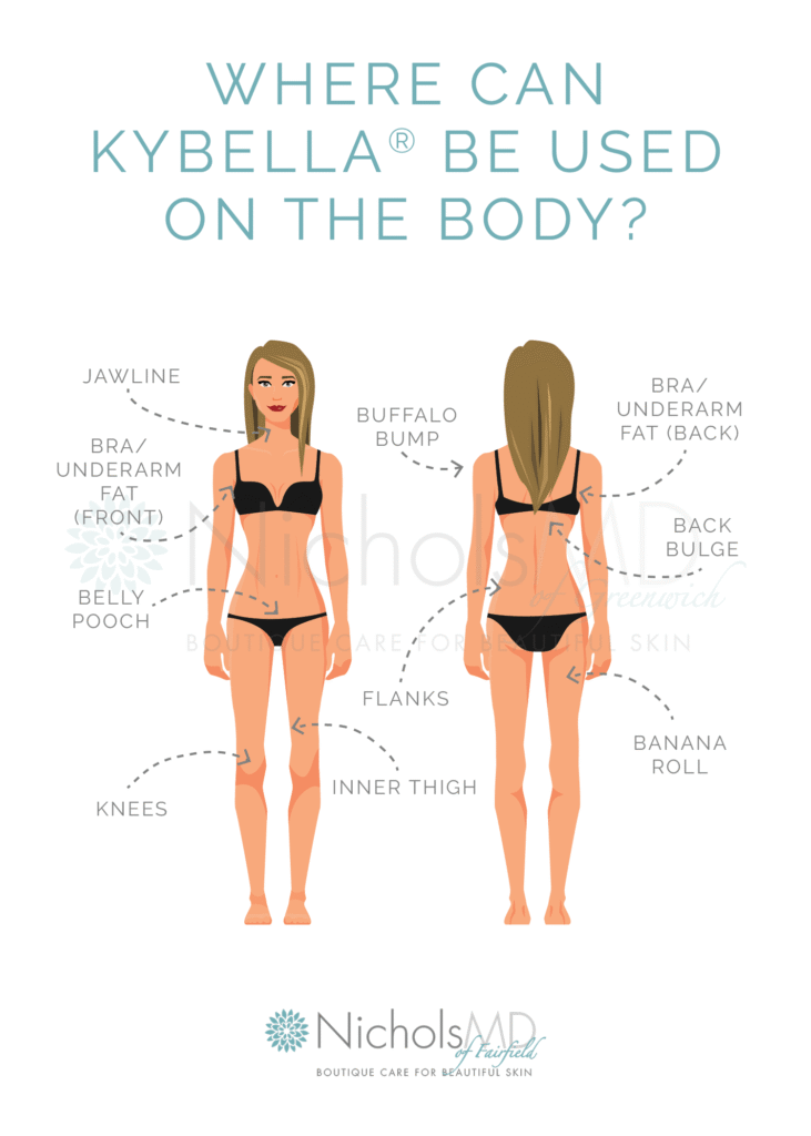 Infographic titled "Where Can Kybella Be Used on the Body?" showing diagram of treatment areas including jawline, bra/underarm fat, belly pooch, banana roll, back bulge, flanks, knees, and inner thigh