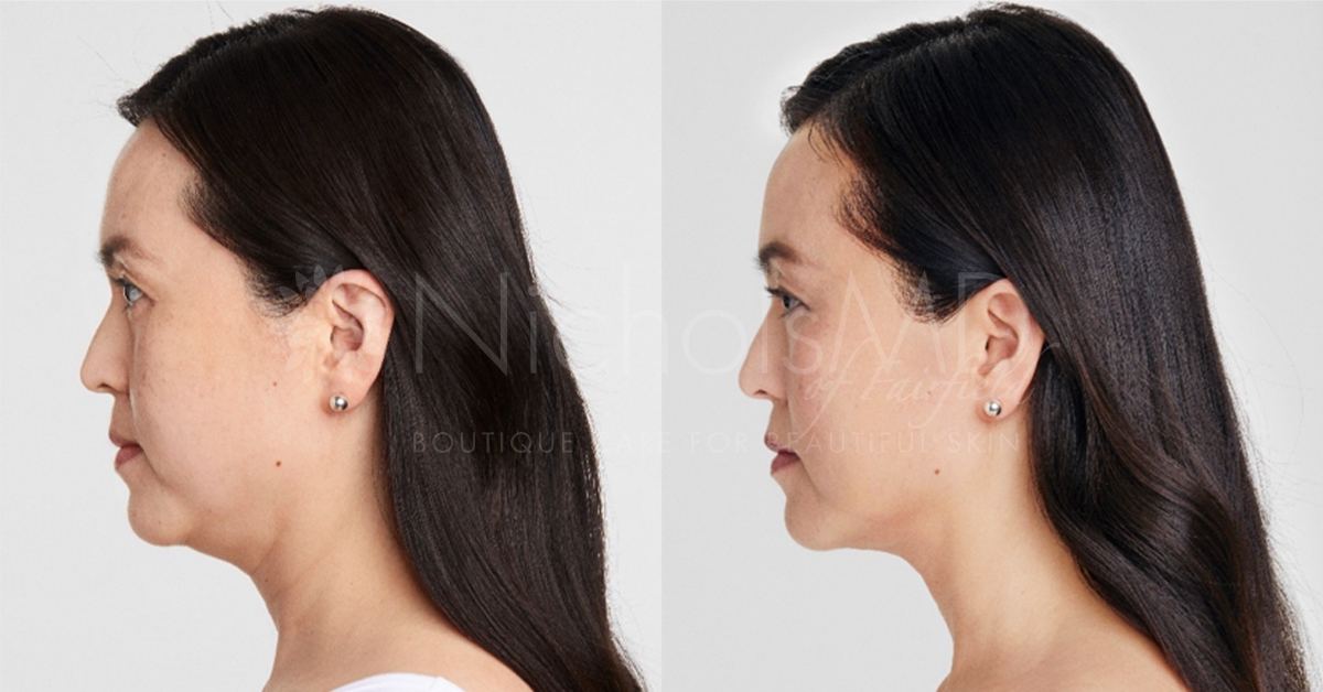 NicholsMD Ultherapy Before and After