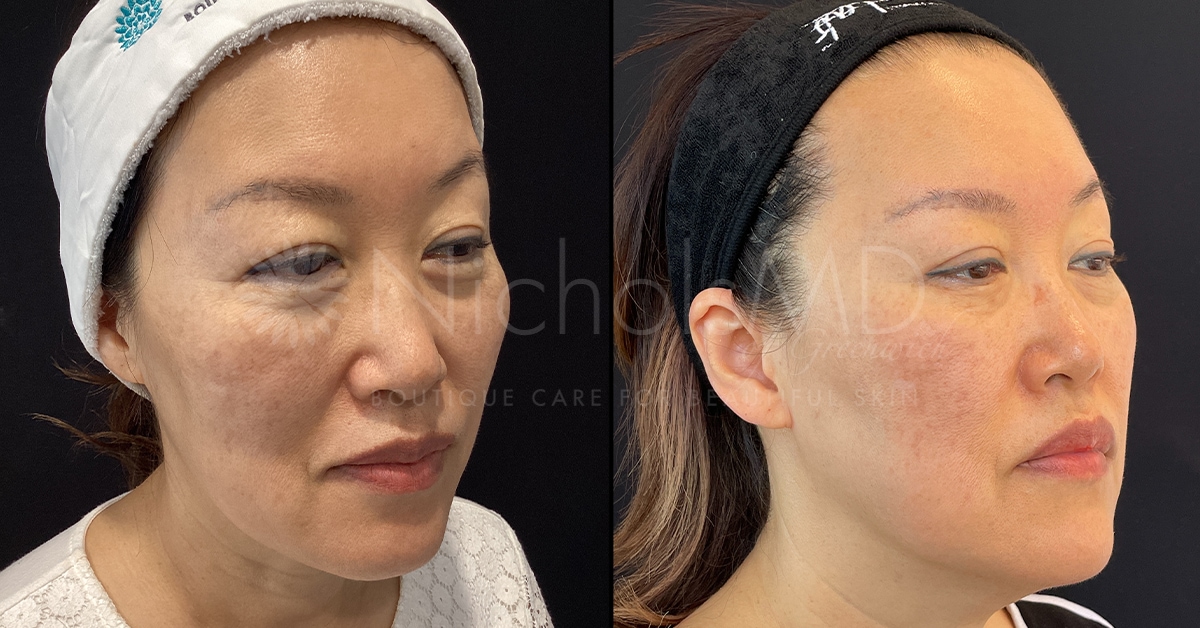 NicholsMD Greenwich Secret Before and After