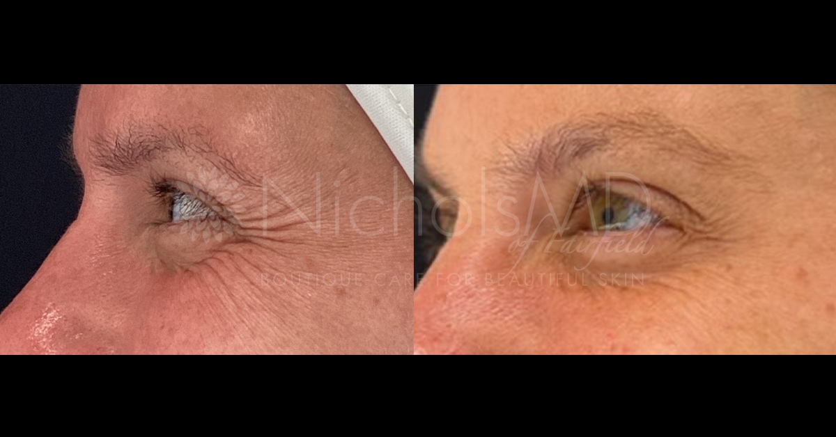 NicholsMD Botox® Eyes Before and After