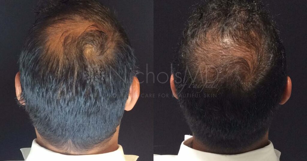 NicholsMD Hair Restoration Before and After